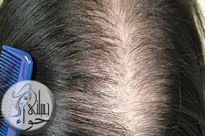 الأثار الجانبية الأكثر شيوعا لزراعة الشعر