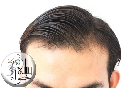 ماذا تعرف عن زراعة الشعر في تركيا؟