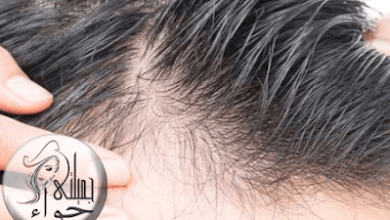 ما تحتاج معرفته عن زراعة الشعر في تركيا